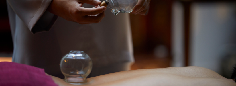 Traditional Chinese Medicine – Cupping Therapy Session Woman receiving cupping treatment as part of traditional Chinese medicine therapy