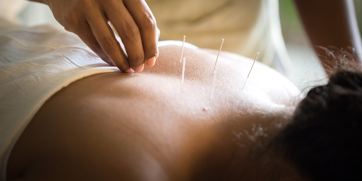 Woman lies on her front as a therapist performs acupuncture on her back